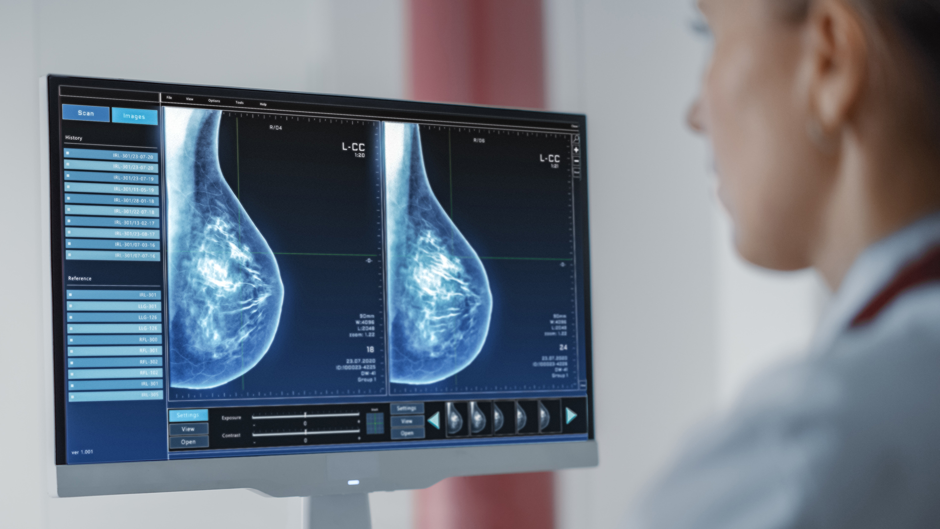 Start-ups entwickeln KI-Tools, um die Diagnose von Brustkrebs zu beschleunigen und die Behandlung zu personalisieren