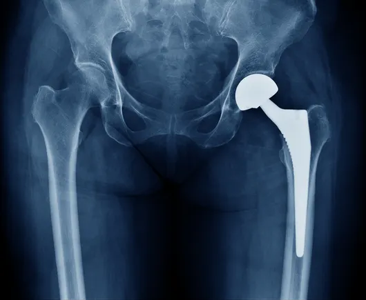 Stryker Lowers 2026 Outlook Amid Slowdown in Hip and Knee Surgeries and Details of CMR Surgical Partnership